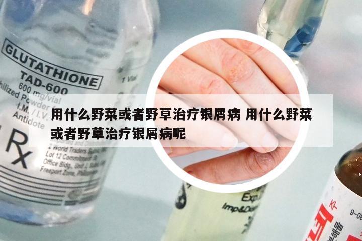用什么野菜或者野草治疗银屑病 用什么野菜或者野草治疗银屑病呢