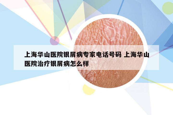 上海华山医院银屑病专家电话号码 上海华山医院治疗银屑病怎么样