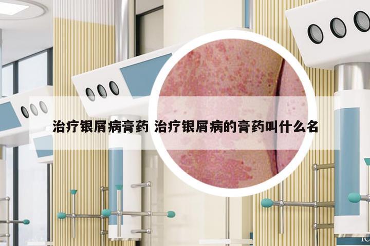 治疗银屑病膏药 治疗银屑病的膏药叫什么名
