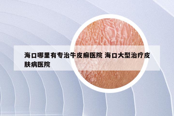 海口哪里有专治牛皮癣医院 海口大型治疗皮肤病医院