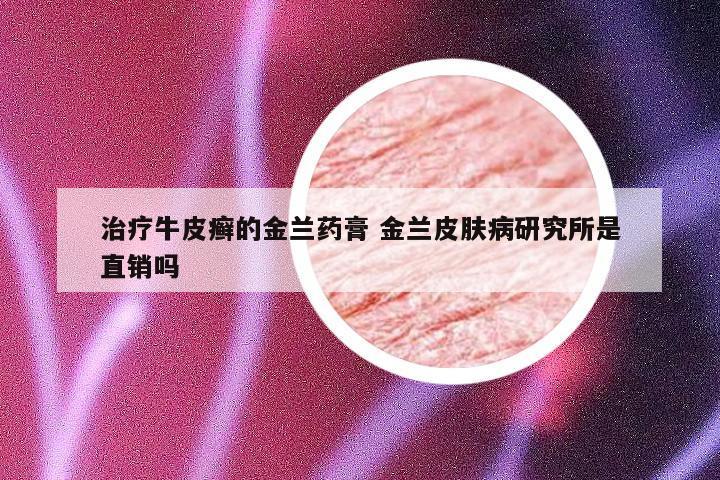 治疗牛皮癣的金兰药膏 金兰皮肤病研究所是直销吗
