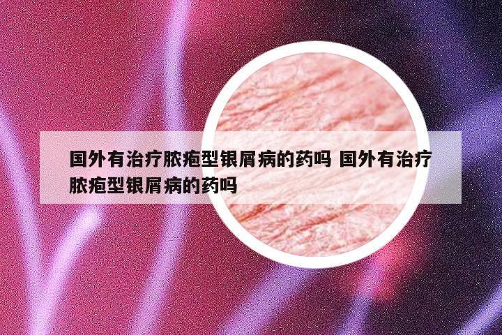 国外有治疗脓疱型银屑病的药吗 国外有治疗脓疱型银屑病的药吗
