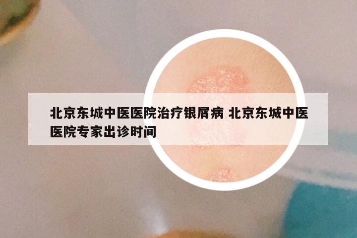 北京东城中医医院治疗银屑病 北京东城中医医院专家出诊时间