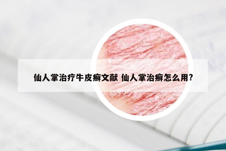 仙人掌治疗牛皮癣文献 仙人掌治癣怎么用?