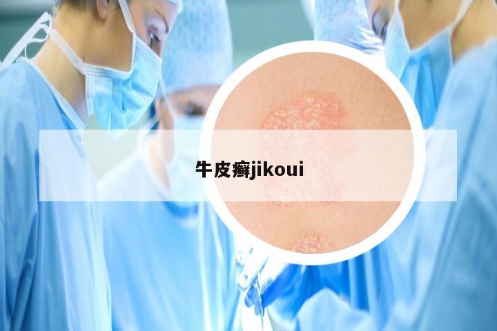 牛皮癣jikoui
