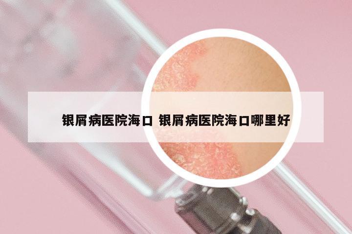 银屑病医院海口 银屑病医院海口哪里好