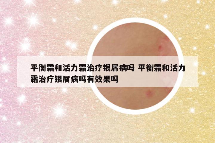 平衡霜和活力霜治疗银屑病吗 平衡霜和活力霜治疗银屑病吗有效果吗