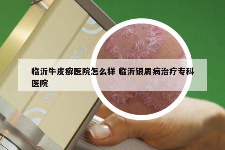 临沂牛皮癣医院怎么样 临沂银屑病治疗专科医院