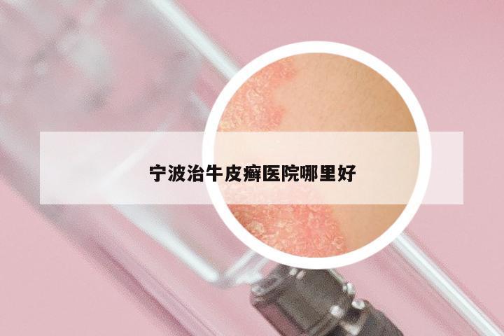 宁波治牛皮癣医院哪里好