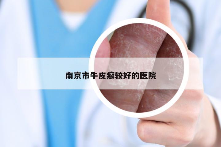 南京市牛皮癣较好的医院
