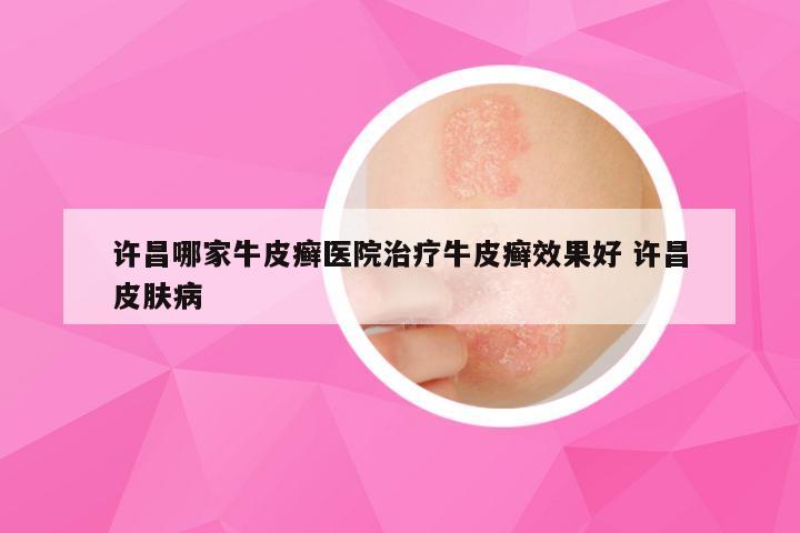 许昌哪家牛皮癣医院治疗牛皮癣效果好 许昌皮肤病
