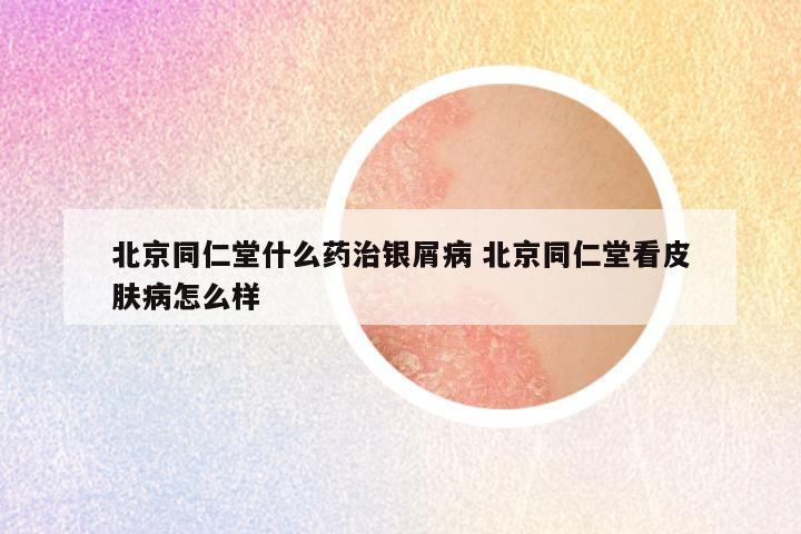 北京同仁堂什么药治银屑病 北京同仁堂看皮肤病怎么样