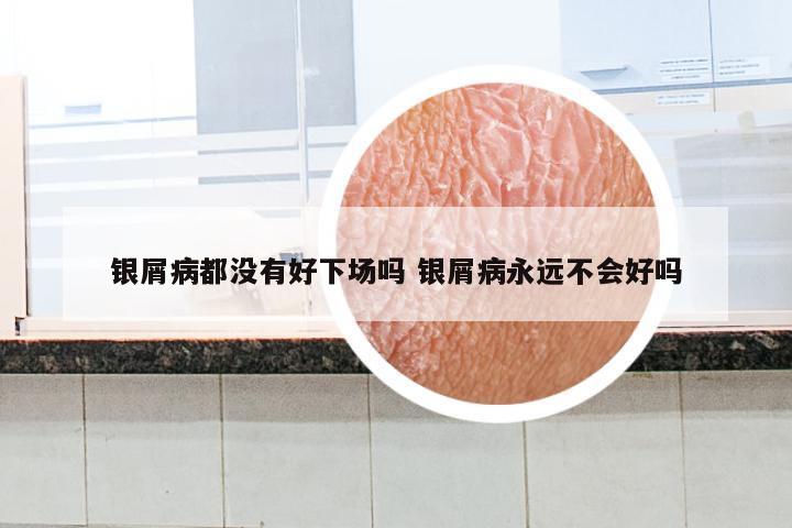 银屑病都没有好下场吗 银屑病永远不会好吗