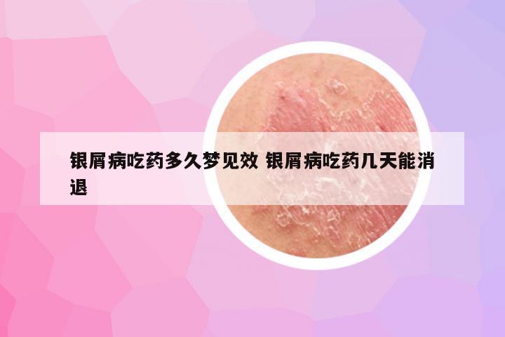 银屑病吃药多久梦见效 银屑病吃药几天能消退