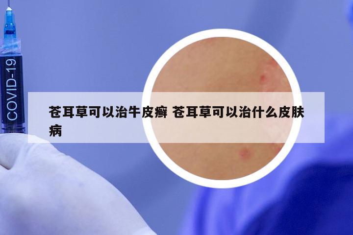 苍耳草可以治牛皮癣 苍耳草可以治什么皮肤病