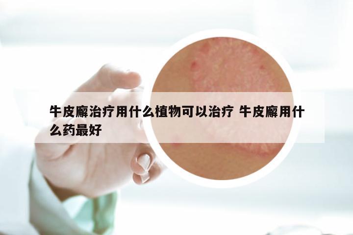 牛皮廨治疗用什么植物可以治疗 牛皮廨用什么药最好
