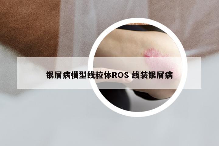 银屑病模型线粒体ROS 线装银屑病