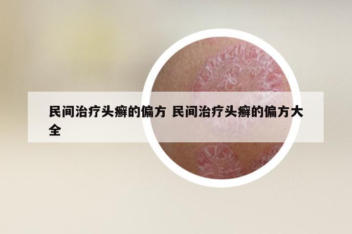 民间治疗头癣的偏方 民间治疗头癣的偏方大全