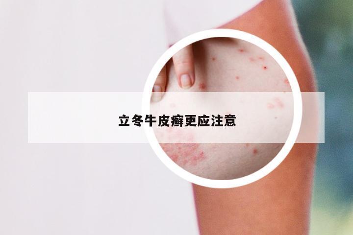 立冬牛皮癣更应注意