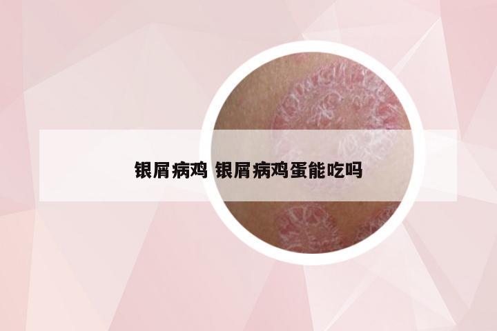 银屑病鸡 银屑病鸡蛋能吃吗