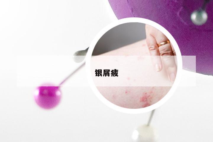 银屑疲