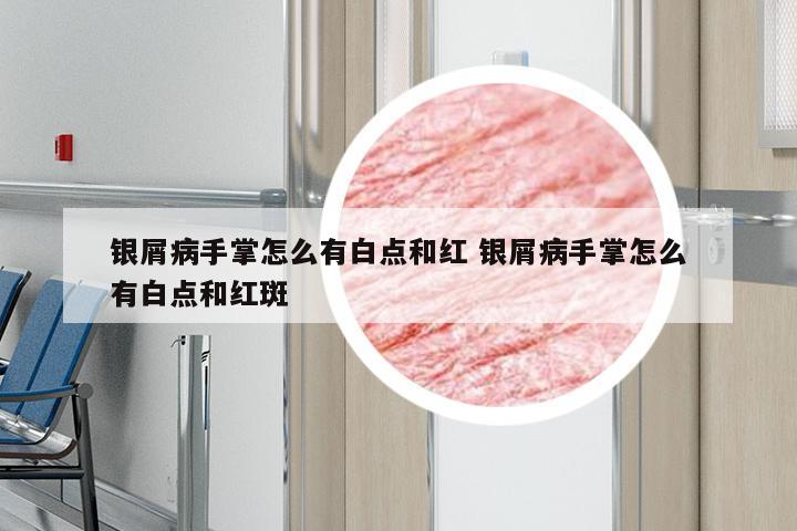 银屑病手掌怎么有白点和红 银屑病手掌怎么有白点和红斑
