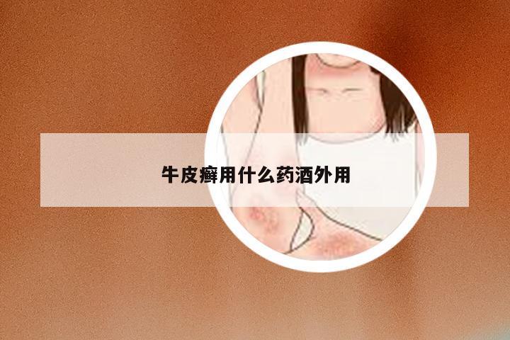 牛皮癣用什么药酒外用