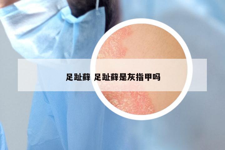 足趾藓 足趾藓是灰指甲吗