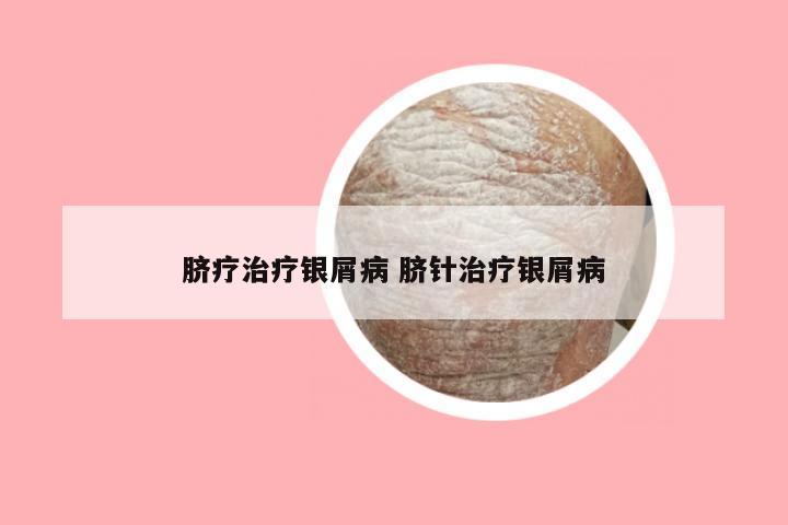 脐疗治疗银屑病 脐针治疗银屑病