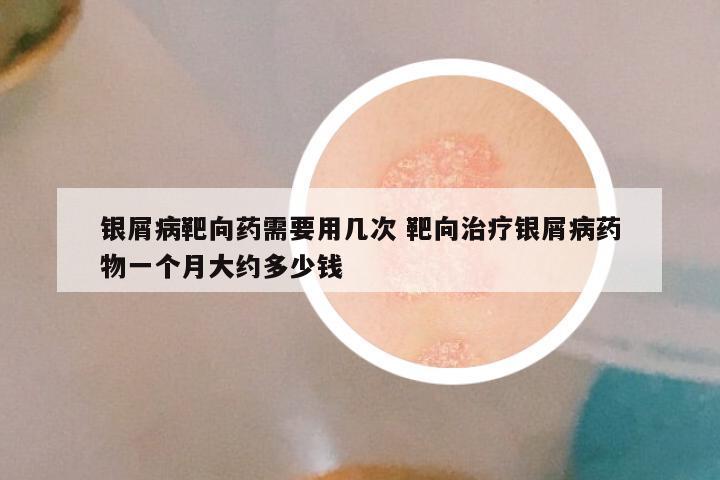 银屑病靶向药需要用几次 靶向治疗银屑病药物一个月大约多少钱