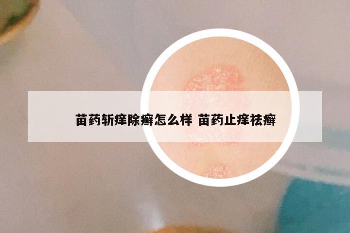 苗药斩痒除癣怎么样 苗药止痒祛癣