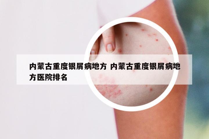内蒙古重度银屑病地方 内蒙古重度银屑病地方医院排名