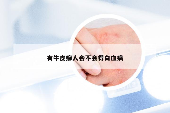 有牛皮癣人会不会得白血病