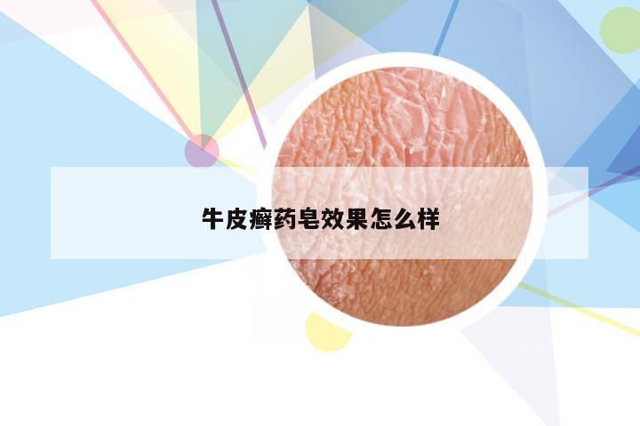 牛皮癣药皂效果怎么样