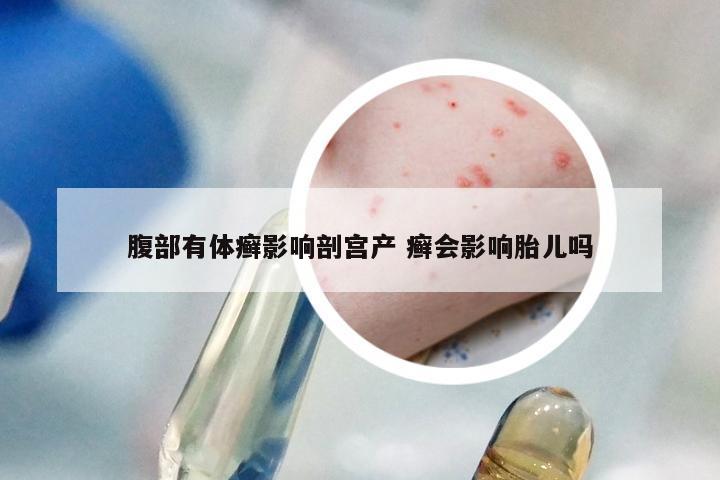 腹部有体癣影响剖宫产 癣会影响胎儿吗
