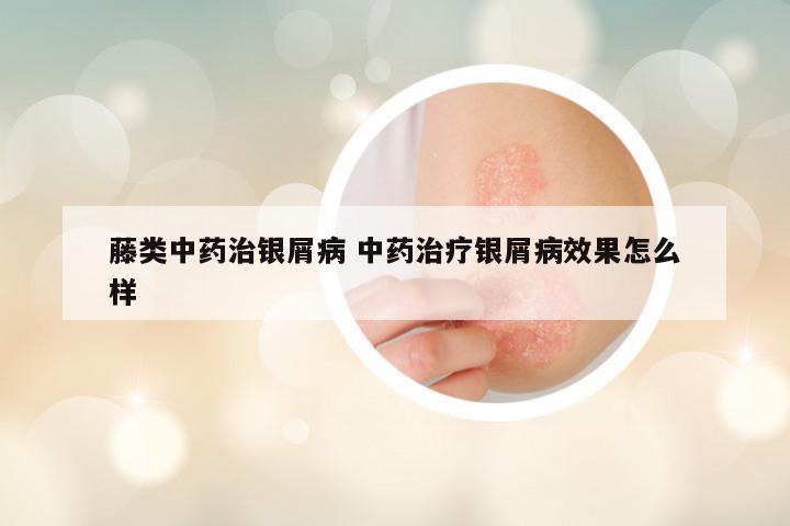 藤类中药治银屑病 中药治疗银屑病效果怎么样