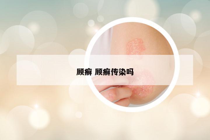 顾癣 顾癣传染吗