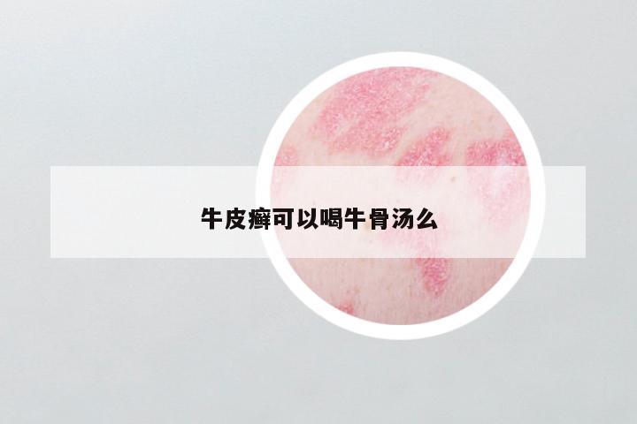 牛皮癣可以喝牛骨汤么