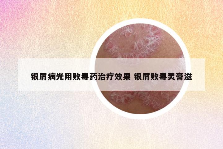 银屑病光用败毒药治疗效果 银屑败毒灵膏滋