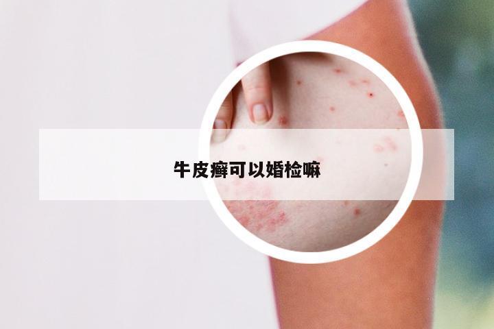 牛皮癣可以婚检嘛