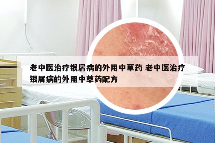 老中医治疗银屑病的外用中草药 老中医治疗银屑病的外用中草药配方