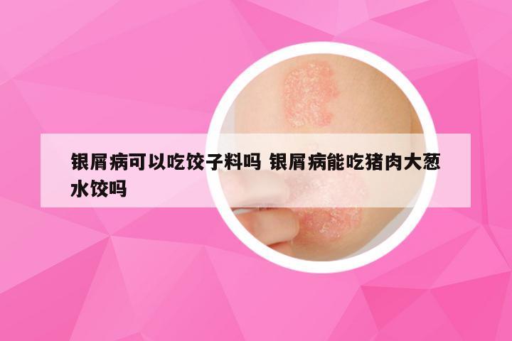 银屑病可以吃饺子料吗 银屑病能吃猪肉大葱水饺吗