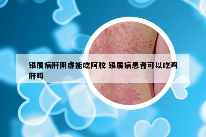 银屑病肝阴虚能吃阿胶 银屑病患者可以吃鸡肝吗