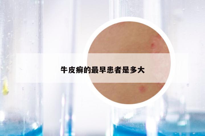 牛皮癣的最早患者是多大