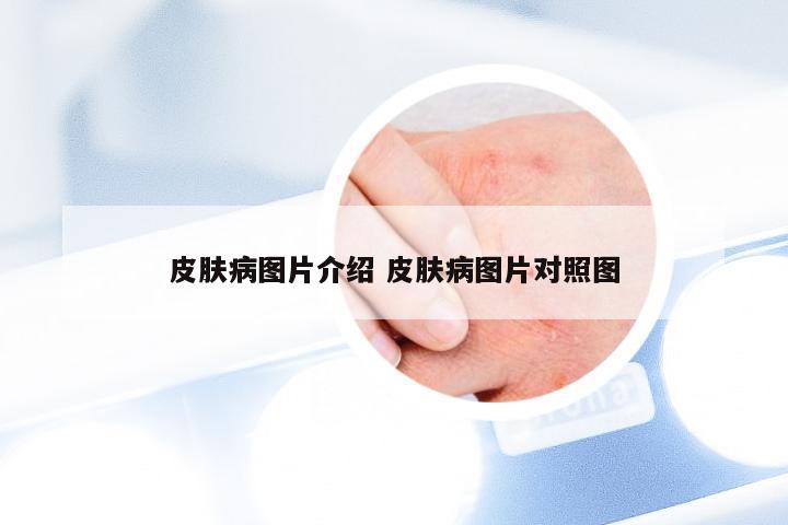 皮肤病图片介绍 皮肤病图片对照图