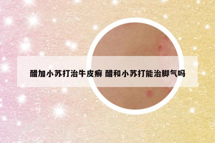 醋加小苏打治牛皮癣 醋和小苏打能治脚气吗