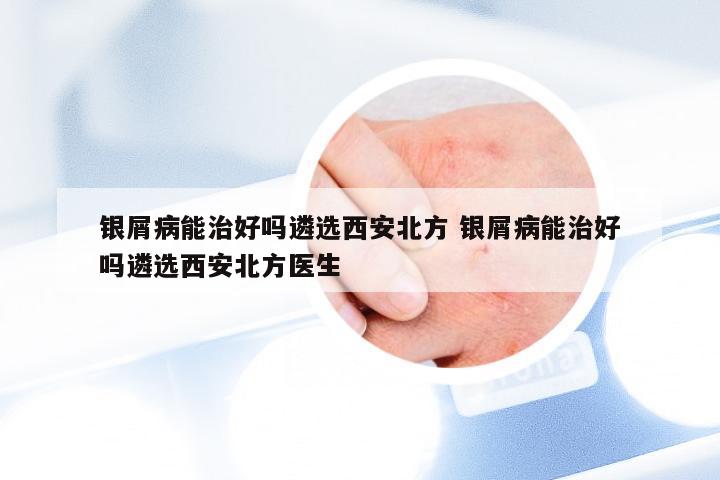 银屑病能治好吗遴选西安北方 银屑病能治好吗遴选西安北方医生