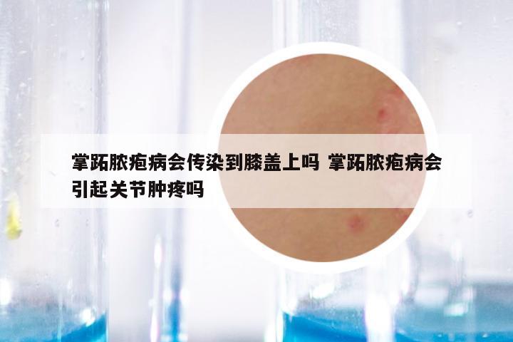 掌跖脓疱病会传染到膝盖上吗 掌跖脓疱病会引起关节肿疼吗