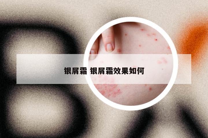 银屑霜 银屑霜效果如何