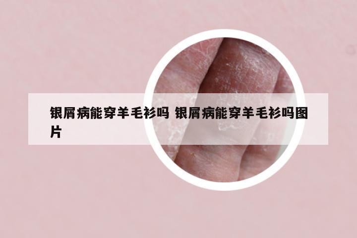银屑病能穿羊毛衫吗 银屑病能穿羊毛衫吗图片